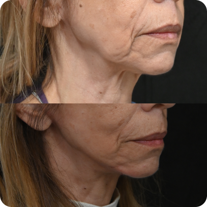 Facelift