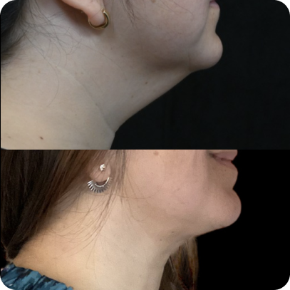 Lipectomía Cervical